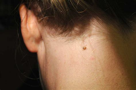 Ticks Spread Plenty More For You To Worry About Beyond Lyme Disease