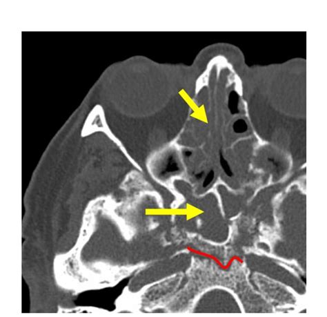 Computed Tomography Of The Paranasal Sinuses Axial Plane And Bone