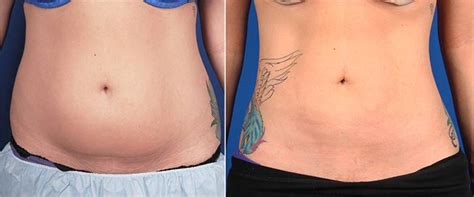 Liposuction Before And After Photos Palm Desert Palm Springs Contour Dermatology