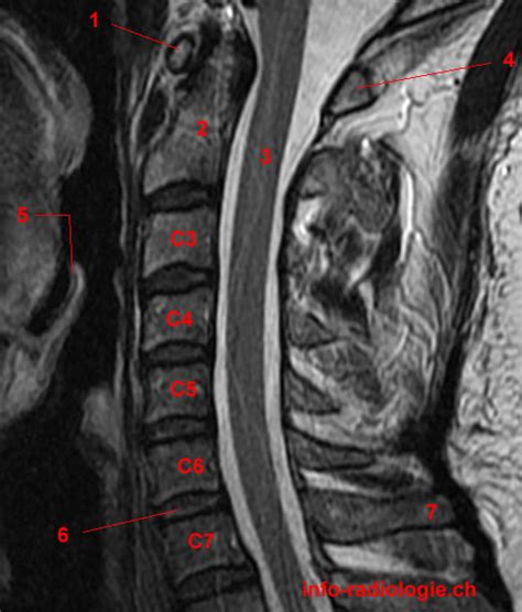 Mri Of The Cervical Spine Anatomy