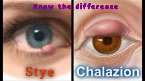 Difference Between Stye And Chalazion Youtube