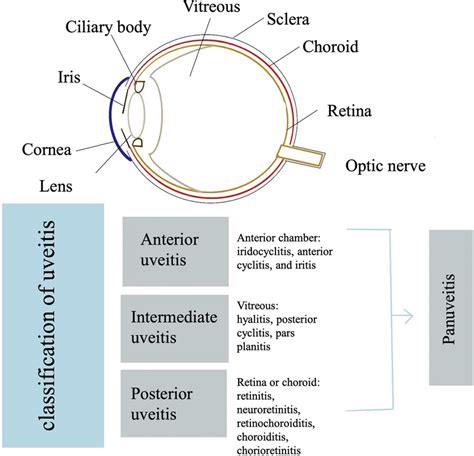 Classification Of Uveitis Based On Anatomic Sites Download Scientific