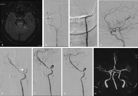 Frontiers Staged Endovascular Treatment For Symptomatic Occlusion