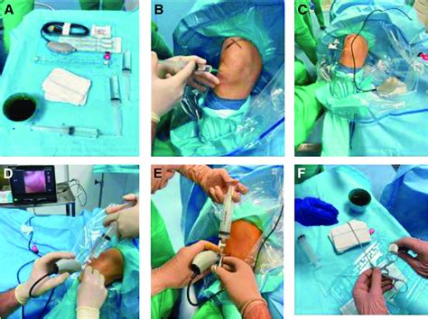 Diagnostic Steps And Approaches For In Office Needle Arthroscopy A