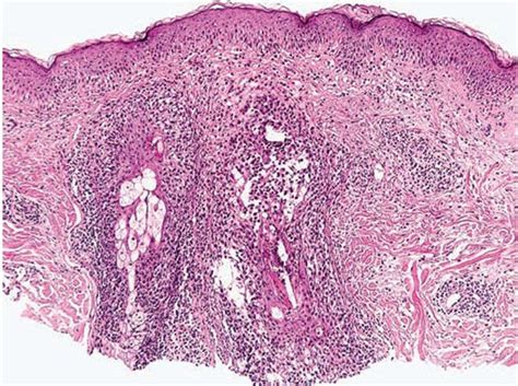 Eosinophilic Pustular Folliculitis Histology