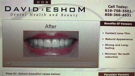 Porcelain Veneers San Diego Dentist David Eshom Youtube