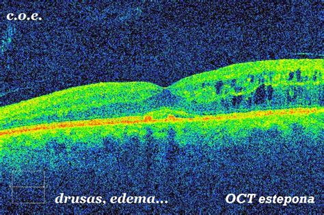 Degeneracion Macular Oct Retina