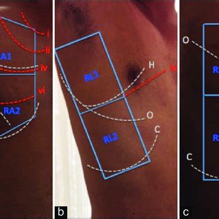 Four Ultrasound Patterns According To Lung Aeration A Normal