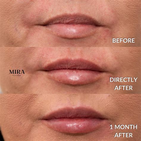 Diagram Botox Lip Flip Injection Points