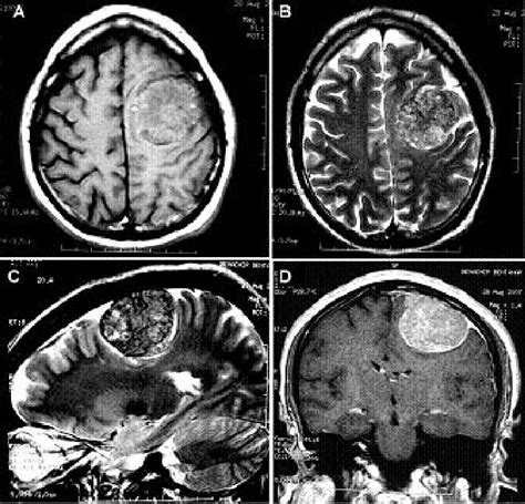 IRM cérébrale en Sp T1 avant injection du gadolinium A et après