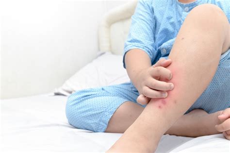 Flea Bites Symptoms Treatments And Prevention Guide Planet