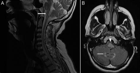 Teaching Neuroimages Neuroimaging In Adult Onset Alexander Disease