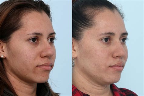 Fraxel Laser Before And After Photo Gallery