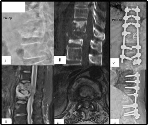 I Lateral X Ray Showing Significant Destruction Of D12 L1 Vertebrae