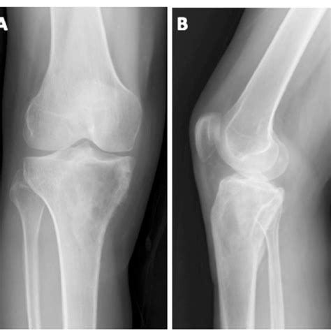 A Anteroposterior And B Lateral Radiographs Of The Left Knee In A 52 Download Scientific