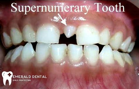 Supernumerary Tooth Emerald Dental