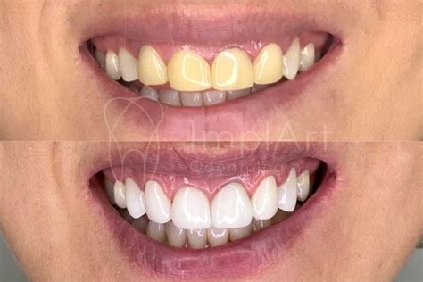 Lentes De Contato Dental Antes E Depois 47kb ImplArt