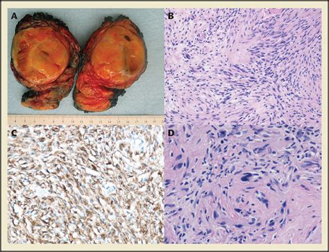 Juxta Adrenal Ancient Schwannoma A Rare Retroperitoneal Tumor