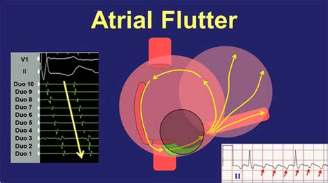 Atrial Flutter Causes Symptoms And Herbal Remedies