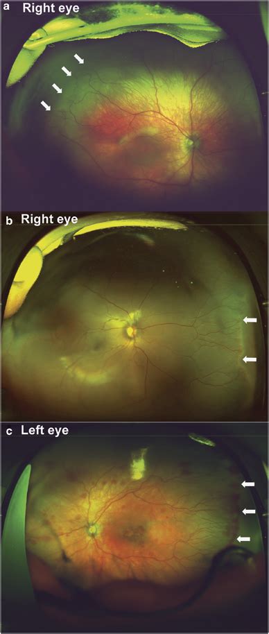 Pseudo Colour Fundal Optos Image Of A Babys Right Eye With Stage