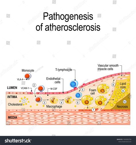 Atherosclerosis Pathophysiology