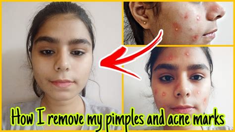 Home Remedies To Get Rid Of Pimples Fast Youtube