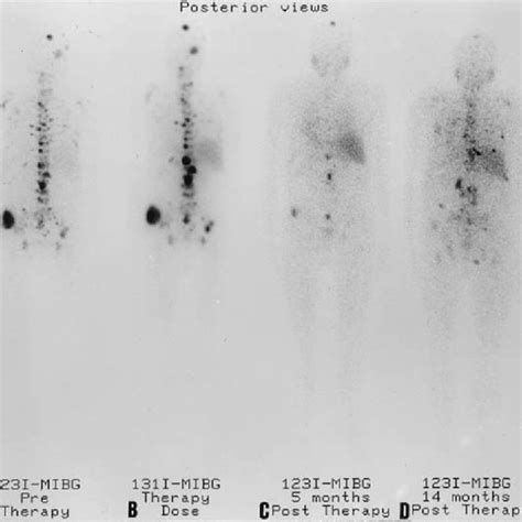 A I Mibg Whole Body Image H Post Injection Showing Multiple