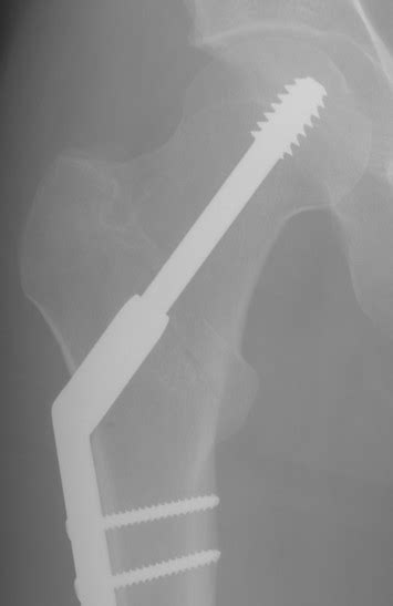 Dynamic Hip Screw St3 Ortho Interview Questions