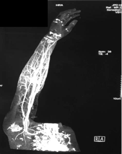 A CT Angiogram Right Upper Limb B CTA Right Upper Limb At 6 Weeks