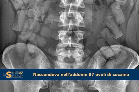 Nascondeva Nell Addome 87 Ovuli Di Cocaina La Settimana TV