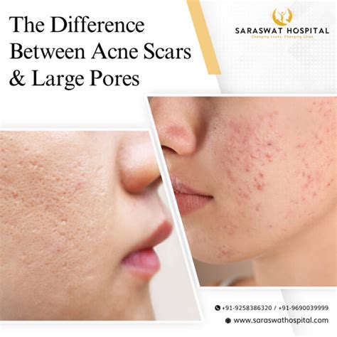 How To Differentiate Between Acne Scars And Large Pores