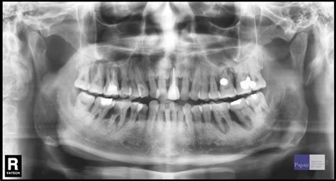 Novembro Radiologia Odontol Gica Aplicada Periodontia Lii