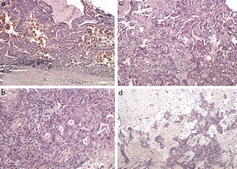 Scielo Brasil Synchronous Multiple Unilateral Parotid Gland Tumors