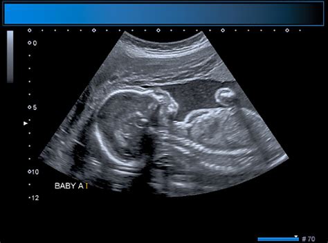 Identical Twin Boy Obstetrical Ultrasound Stock Photo - Download Image ...