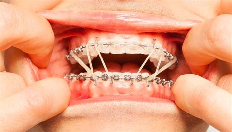 Gomas En Los Brackets ¿para Qué Se Utilizan Clínica Dental Soria Vizcaíno