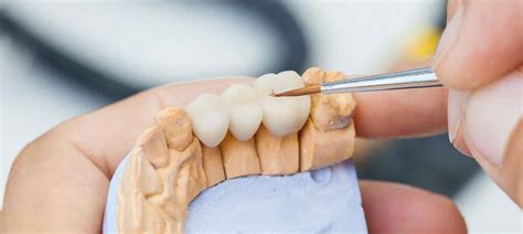 All to know about Full And Partial Dental Bridge | Healing Clinic Turkey