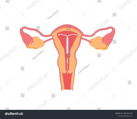 Intrauterine Device Iud Uterus Female Contraception Stock Vector