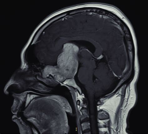 Resonancia Magnética Cerebral Corte Sagital En T1 Que Muestra Un