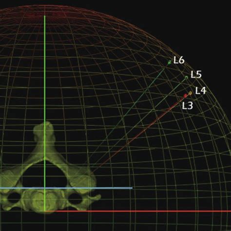 The Transverse Angle Of Ideal Trajectory Of Pedicle Screw Insertion