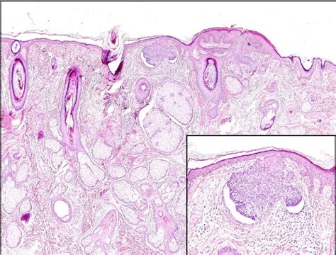 Figure 2 From A Case Of Keratoacanthoma Associated With Basal Cell