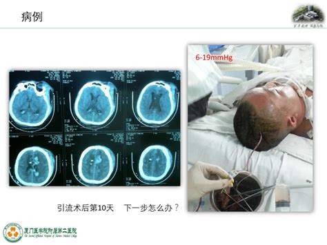 监测有道丨弥漫性轴索损伤并发脑室积血颅内压监测一例颅脑创伤 神经重症周刊第196期 脑医汇 神外资讯 神介资讯