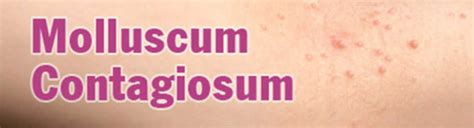 Symptoms Causes Diagnosis Of Molluscum Contagiosum