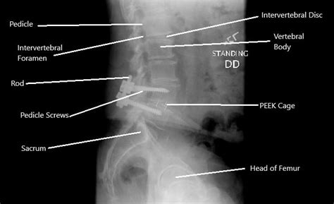 Spondylolisthesis - Complete Orthopedics & Podiatry | Multiple NY Locations