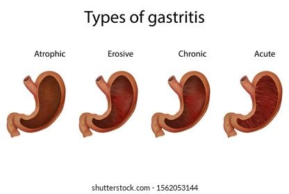 Vector Illustration Types Gastritis Stock Vector Royalty Free