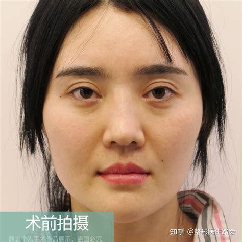 33岁江苏姑娘整容后激动地说：“填平了泪沟和法令纹，显老的特征没了，看上去像23岁！” 知乎