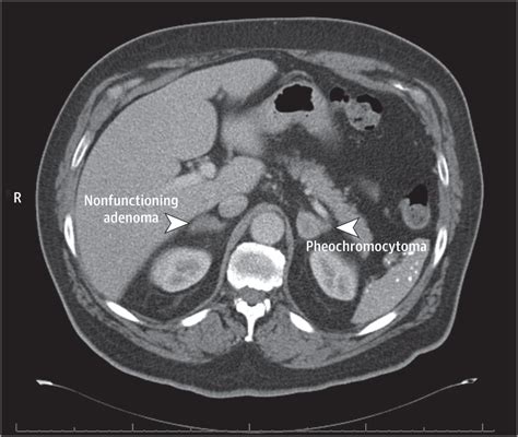 Differences Between Bilateral Adrenal Incidentalomas And Unilateral