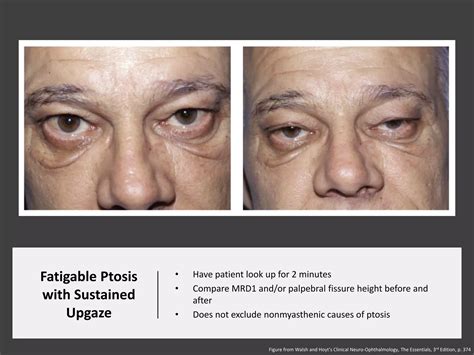 Ocular Myasthenia Gravis Ppt