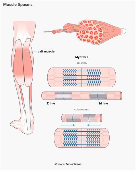 Muscle spasms: Causes, symptoms, and treatment