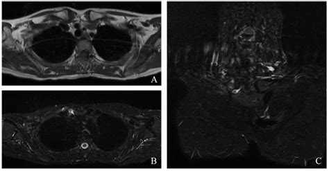 Chest Magnetic Resonance Imaging At The Level Of The Right