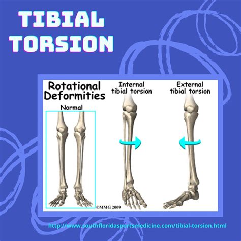 External Tibial Torsion